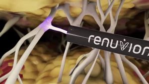 Renuvion® – Innovative Technologie für straffe Haut